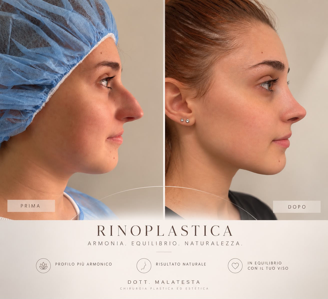 Confronto prima e dopo di rinoplastica, profilo nasale
